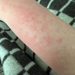 Rejuvenation and Well Being - Burning Rash