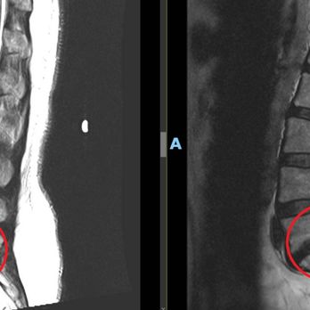 ProSpinal - See the difference! Pre- and Post-Decompression therapy at ProSpinal helps relieve spinal pressure and improve mobility. - Chiropractors Near Me - Reno, Nevada ProSpinal - See the difference! Pre- and Post-Decompression therapy at ProSpinal helps relieve spinal pressure and improve mobility. - Chiropractors Near Me - Reno, Nevada