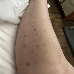 A simple rash that showed up within days of the second individual dose of Opdivo. A simple rash that showed up within days of the second individual dose of Opdivo.