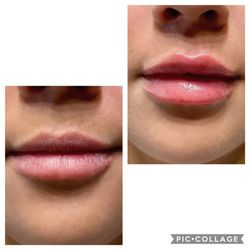 Boutique Medspa - Love Kysse for lips!!!