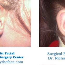 Parfitt Facial Cosmetic Surgery Center - Ear Surgery Madison WI