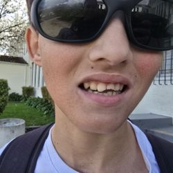 Concord Dental Group & Loveridge Dental Group - Broken front teeth