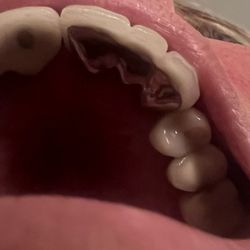 Burien Signature Dentistry - Patients bridge