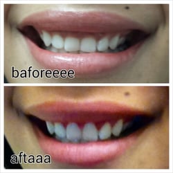 Mark C Fagan, DDS - Before and after crown lengthening. Notice the curvature of the top of the teeth and how much bigger they are. Huge difference!