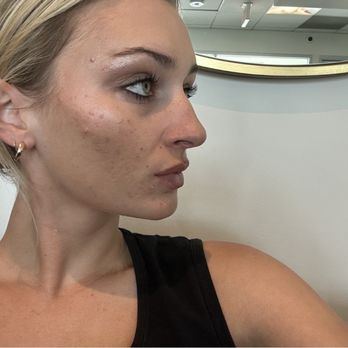 Skincare by Carla - Vi chemical peel - Estheticians Near Me - San Mateo, California Skincare by Carla - Vi chemical peel - Estheticians Near Me - San Mateo, California
