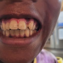 Hook Orthodontics - BEFORE