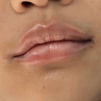 Allure Derm & Wellness Center - Right after 2nd appt. she injects 1st half of syringe in first appt, then injects the rest of the same syringe in 2nd appt. - Medical Spas Near Me - Ewa Beach, Hawaii