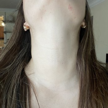 Bee Naturals - Cuts from both sides of my chin from the dermaplaning - Cosmetics & Beauty Supply Near Me - Maplewood, Missouri