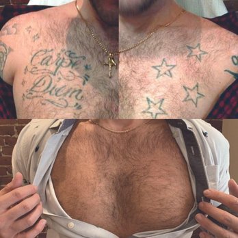 Removery - Before & After Chest Tattoo Removal - Tattoo Removal Near Me - Milwaukee, Wisconsin Removery - Before & After Chest Tattoo Removal - Tattoo Removal Near Me - Milwaukee, Wisconsin