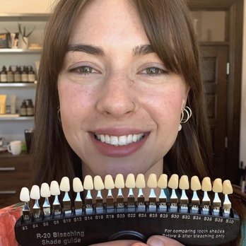 WhiteNow - Patient Rachel showcasing WhiteNows whitening levels post care. - Teeth Whitening Near Me - Dallas, Texas WhiteNow - Patient Rachel showcasing WhiteNows whitening levels post care. - Teeth Whitening Near Me - Dallas, Texas