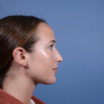 Dallas Rhinoplasty Center: C. Spencer Cochran MD - Pre-op - Cosmetic Surgeons Near Me - Dallas, Texas