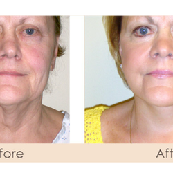 Michael Gray and Skindeep Spa - Facelift Cosmetic Surgery Med Spa