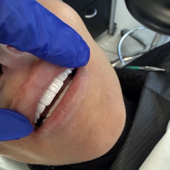 Agoura Advanced Dentistry - Beautiful 12 unit veneer case. - Cosmetic Dentists Near Me - Agoura Hills, California Agoura Advanced Dentistry - Beautiful 12 unit veneer case. - Cosmetic Dentists Near Me - Agoura Hills, California