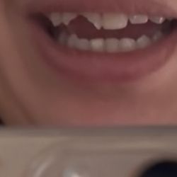 Badly chipped teeth from a fall.