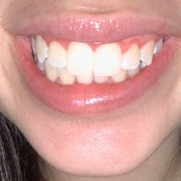 Teeth whitening with 3 consecutive sessions of 20 minutes each by Alexa Teeth whitening with 3 consecutive sessions of 20 minutes each by Alexa