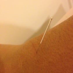 Acupuncture For Pain & Infertility - Wrist pain