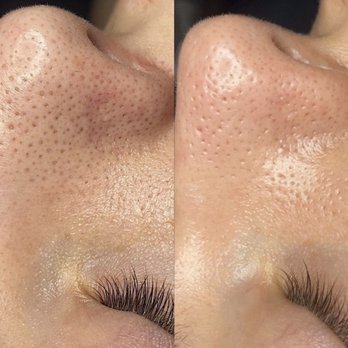 Oh Beauty Bar - Before and after Hydrafacial ( clean pores) - Skin Care Near Me - Bellingham, Washington Oh Beauty Bar - Before and after Hydrafacial ( clean pores) - Skin Care Near Me - Bellingham, Washington