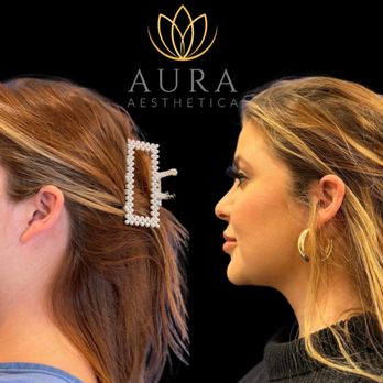 Aura Aesthetica - Chin Liposuction - Plastic Surgeons Near Me - Beverly Hills, California Aura Aesthetica - Chin Liposuction - Plastic Surgeons Near Me - Beverly Hills, California