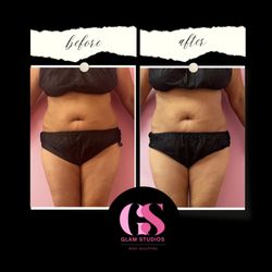 Glam Studios Body Sculpting - Ice Sculpting & Red Light Therapy