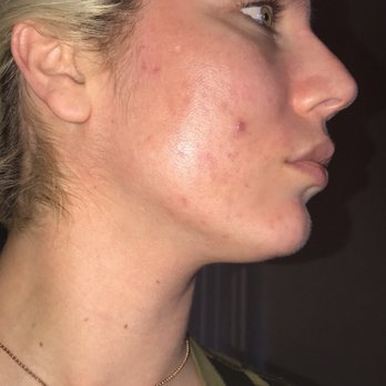 Medical Skin Boutique - After photo of my 1st vi peel - Medical Spas Near Me - Naples, Florida Medical Skin Boutique - After photo of my 1st vi peel - Medical Spas Near Me - Naples, Florida