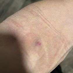 PlasmaCare - Left arm 1 for a total of 4 times. Still to be seen  how much worse these bruises will tomorrow