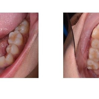 Andy D Kau, DDS - Invisalign: Before - November 2015 - General Dentistry Near Me - Pasadena, California