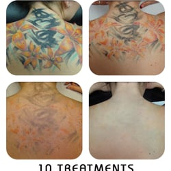 Second Skin Laser - Second Skin Tattoo Removal | Edmonton