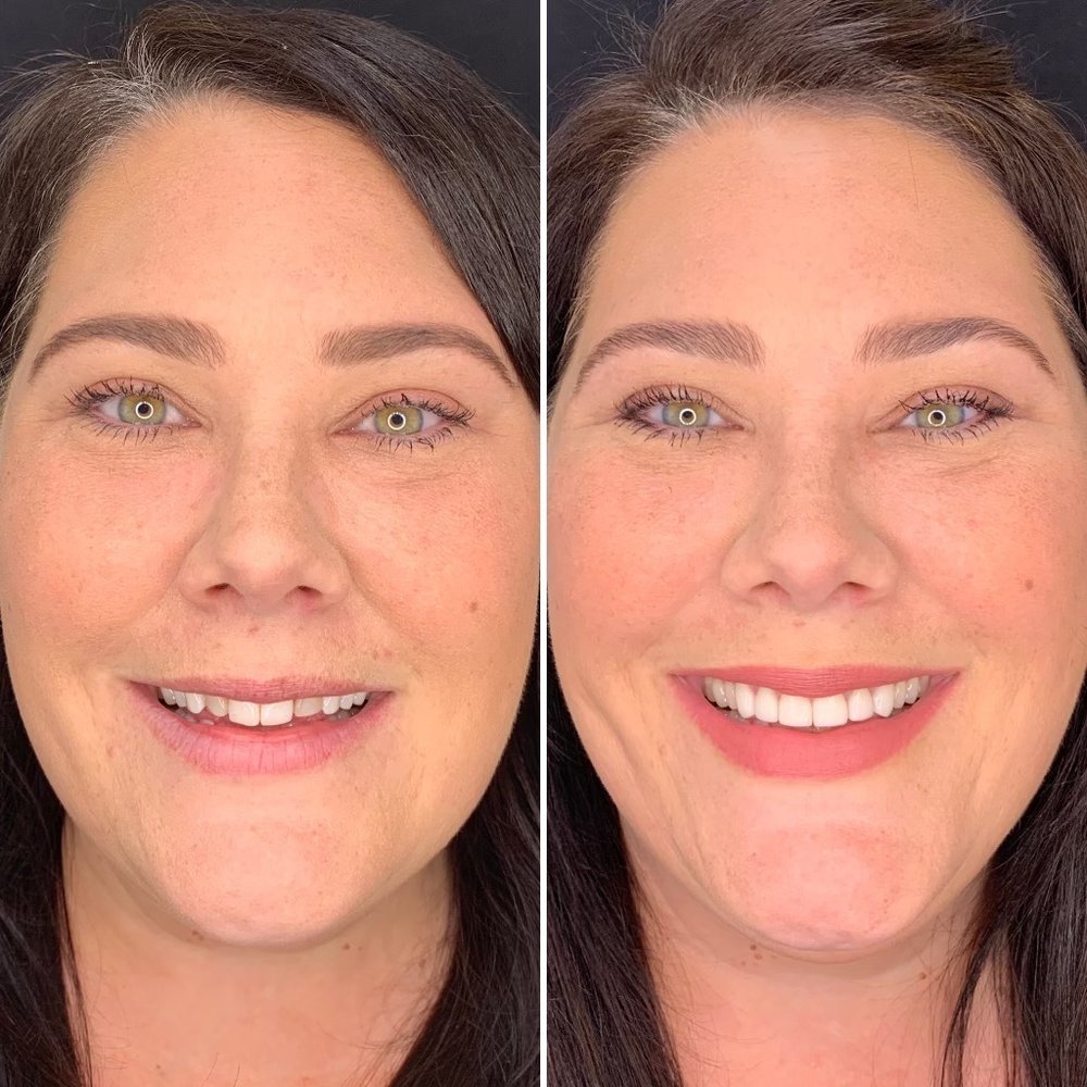 Harrison Dental - Before and after Dr Nealy worked her magic! - General Dentistry Near Me - Boise, Idaho Harrison Dental - Before and after Dr Nealy worked her magic! - General Dentistry Near Me - Boise, Idaho