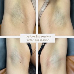 Bare Botanicals Waxing - before + after all natural skin lightening in the underarm area