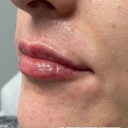 Flawless MedSpa - First time lip filler!