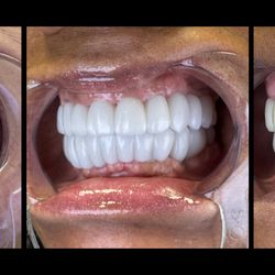 3 On 6 Dental Implants Las Vegas | All out Dental - Keep your gums