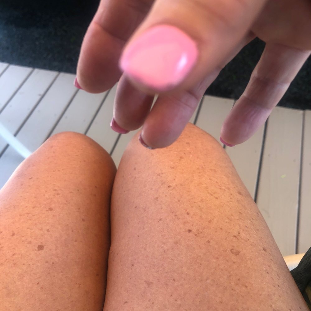 1-2 hard crust above nail . 3 days and chips 1-2 hard crust above nail . 3 days and chips