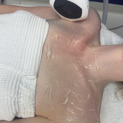 Blue Medi Spa - Intense Pulsed Light (IPL) therapy for sun damage, fine lines, and fading pigmentation
