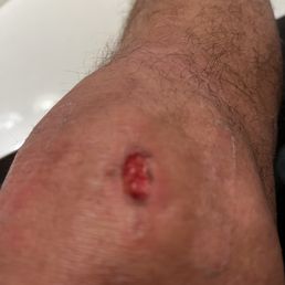 Blister two days after massage from hot stones Blister two days after massage from hot stones