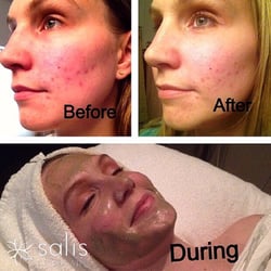Salis Skincare - Wow! Before and after a facial from Salís Skincare.
