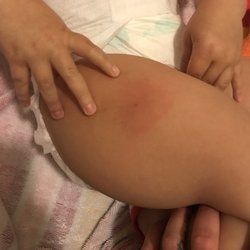 Mission Pediatrics Medical Group - Day two after vaccine