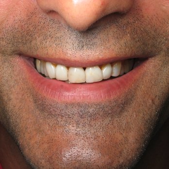 Barry Kliger, DDS - old and worn restorations - General Dentistry Near Me - Sunnyvale, California