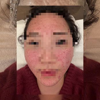 Genesys Laser Clinic - Right after I got the Rejuran - Laser Hair Removal Near Me - New York, New York Genesys Laser Clinic - Right after I got the Rejuran - Laser Hair Removal Near Me - New York, New York