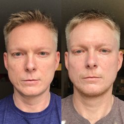 Jordan C Carqueville, MD - Before (left) and after CO2 fractional laser face treatment.