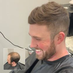 Exclusive Experience Company - 3-5 Month Hair Unit. Male Pattern Baldness, fixed without surgery.