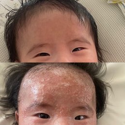 Top: Pic taken 2/9 (2 days after the treatment) Bottom: pic taken 2/6 (a day before the treatment) Top: Pic taken 2/9 (2 days after the treatment) Bottom: pic taken 2/6 (a day before the treatment)