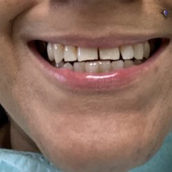 Tahoe Dental Arts - Before photo  gaps and chipped teeth