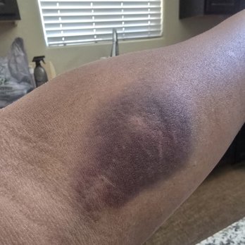 Endless Beauty Med Spa - Severe bruising after using thick gadgets needle to draw blood for PRP microneedling - IV Hydration Near Me - Tempe, Arizona Endless Beauty Med Spa - Severe bruising after using thick gadgets needle to draw blood for PRP microneedling - IV Hydration Near Me - Tempe, Arizona