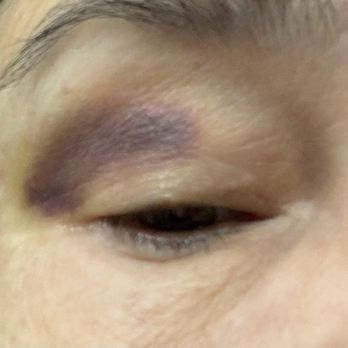 Peach Skin & Laser - Eyelid bruise - Medical Spas Near Me - Tempe, Arizona