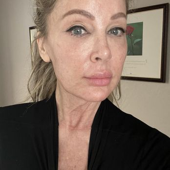 Gerrish MedEsthetics - 1 week post treatment with Matrix RF Microneedling and Ultraclear Erbium Laser. - IV Hydration Near Me - Scottsdale, Arizona Gerrish MedEsthetics - 1 week post treatment with Matrix RF Microneedling and Ultraclear Erbium Laser. - IV Hydration Near Me - Scottsdale, Arizona