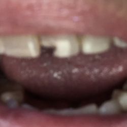 The Tooth Place - When the tooth was progressively chipping away. Very traumatic