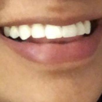 Caleo Bay Orthodontics - Before braces - Orthodontists Near Me - La Quinta, California Caleo Bay Orthodontics - Before braces - Orthodontists Near Me - La Quinta, California