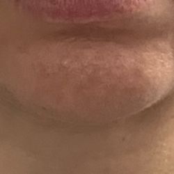 Evolve Med Spa - Montclair - Crooked uneven filler placement