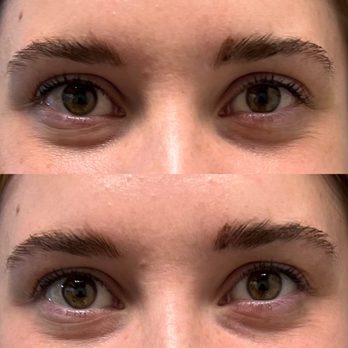 Elevate Wellness and Aesthetics - Upneeq eye drops, before & after - Medical Spas Near Me - Norman, Oklahoma