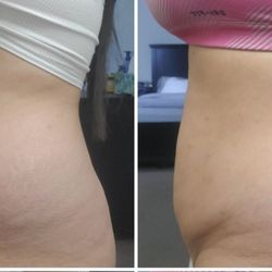 Lotus Spa Body Contour - Left: after 3 treatments and consistent morning jogging and drinking plenty of water. Right: the most recent picture of my results. I'm 36